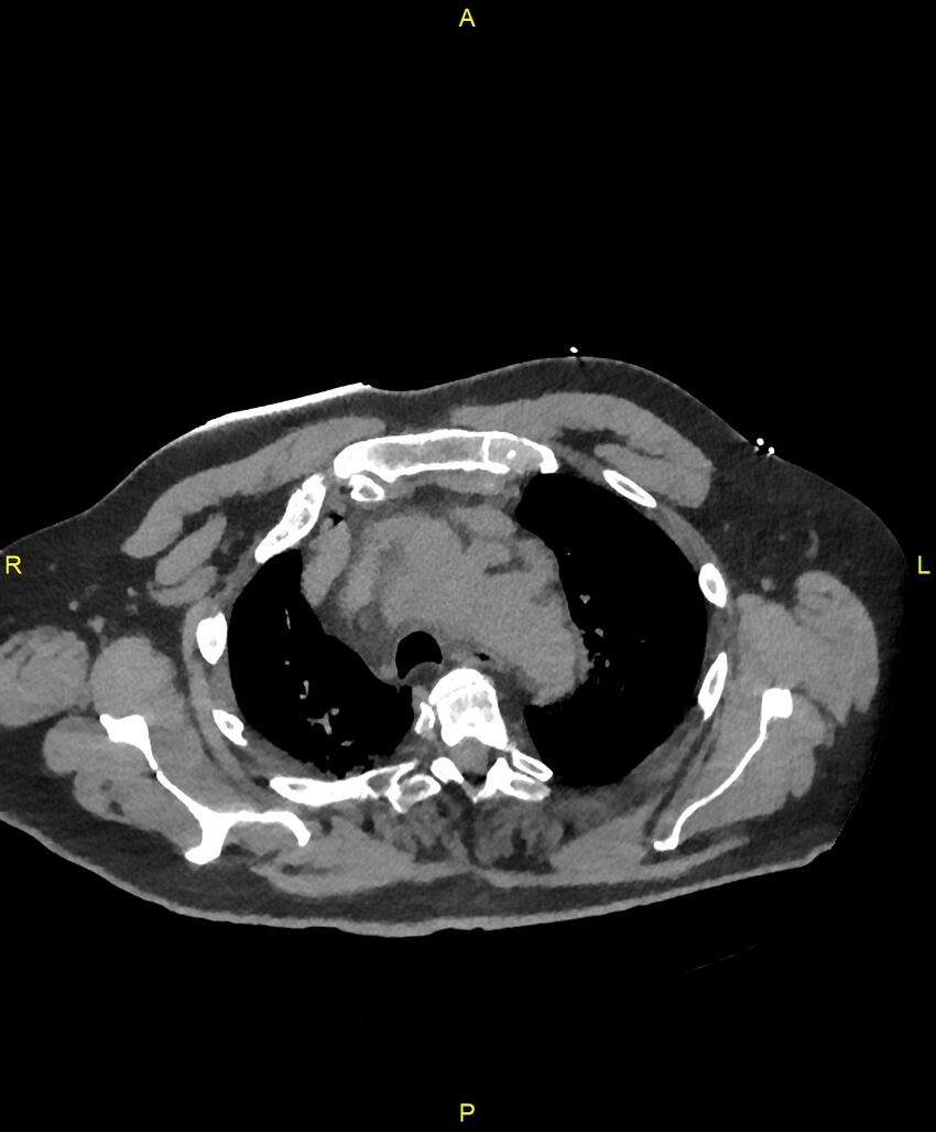 Aortic rupture (Radiopaedia 88822-105594 Axial non-contrast 41).jpg
