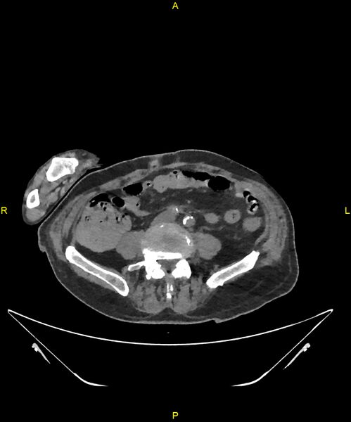 File:Aortoenteric fistula (Radiopaedia 84308-99603 Axial non-contrast 237).jpg
