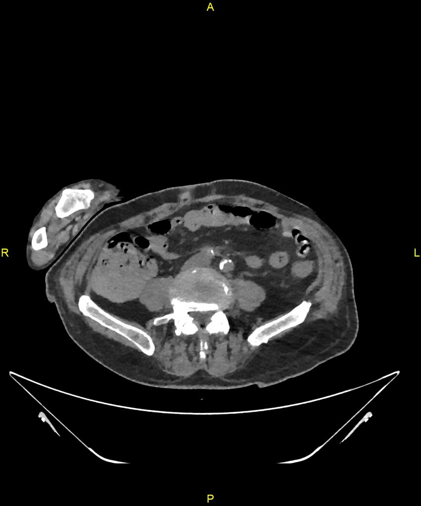 Aortoenteric fistula (Radiopaedia 84308-99603 Axial non-contrast 237).jpg