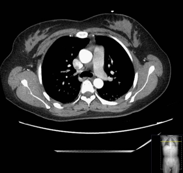 File:Appendicitis (CT angiogram) (Radiopaedia 154713-127660 Axial 211).jpg