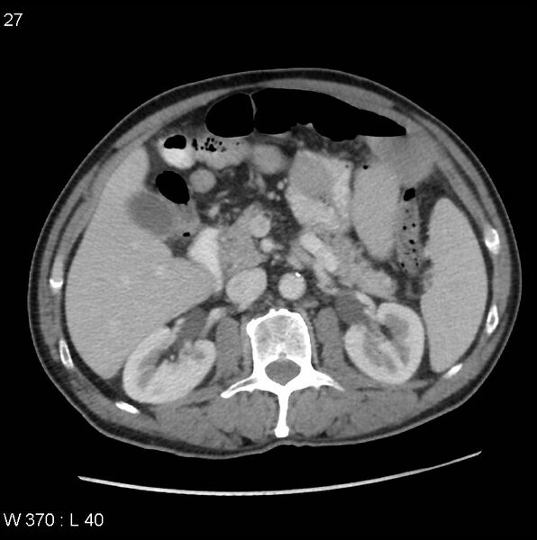 File:Appendicitis (Radiopaedia 27446-27642 A 11).jpg