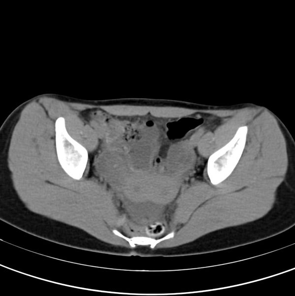 File:Appendicitis and incidental bicornuate uterus (Radiopaedia 22833-22853 Axial non-contrast 40).jpg