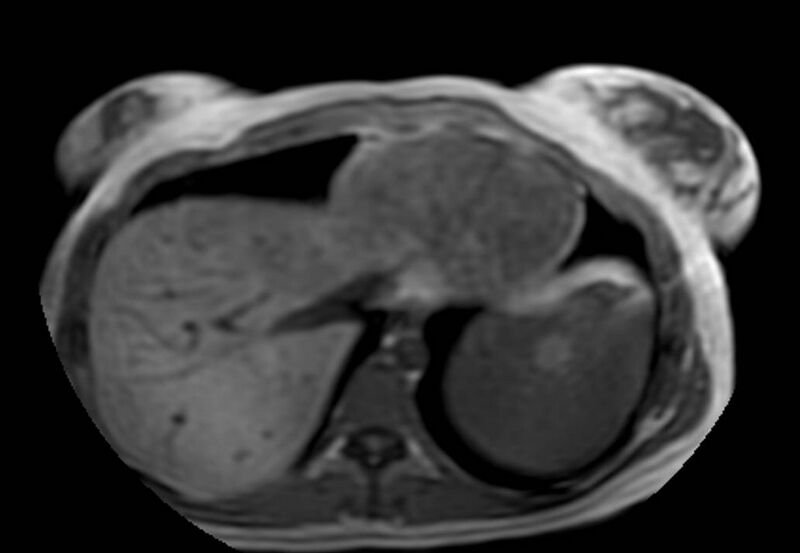 File:Appendicitis in gravida (MRI) (Radiopaedia 89433-106395 Axial T1 in-phase 2).jpg
