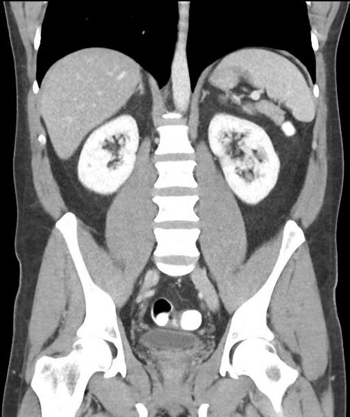 File:Appendicitis with cecal bar sign (Radiopaedia 31878-32830 A 39).jpg