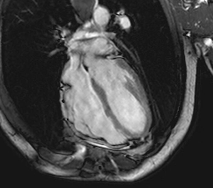 File:Arrhythmogenic right ventricular cardiomyopathy (Radiopaedia 39806-42237 D 32).jpg