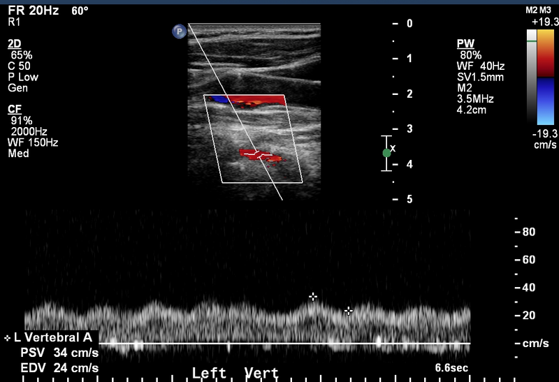 File:Arterial Doppler in left ventricular assist device patients (Radiopaedia 18113-17895 D 1).png