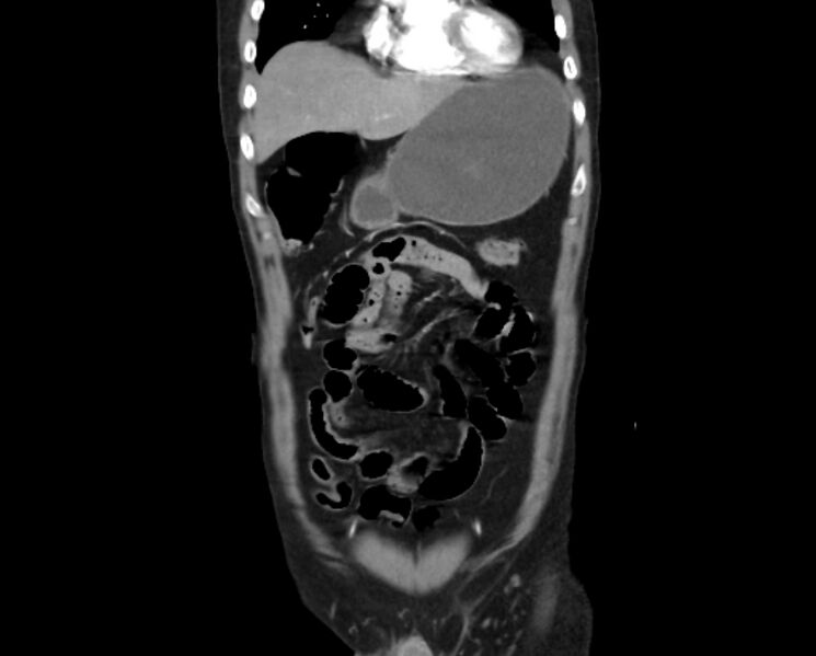 File:Arterial occlusive mesenteric ischemia (Radiopaedia 84641-100060 B 13).jpg