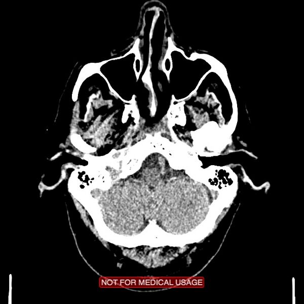 File:Artery of Percheron infarction (Radiopaedia 28679-28967 Axial non-contrast 19).jpg