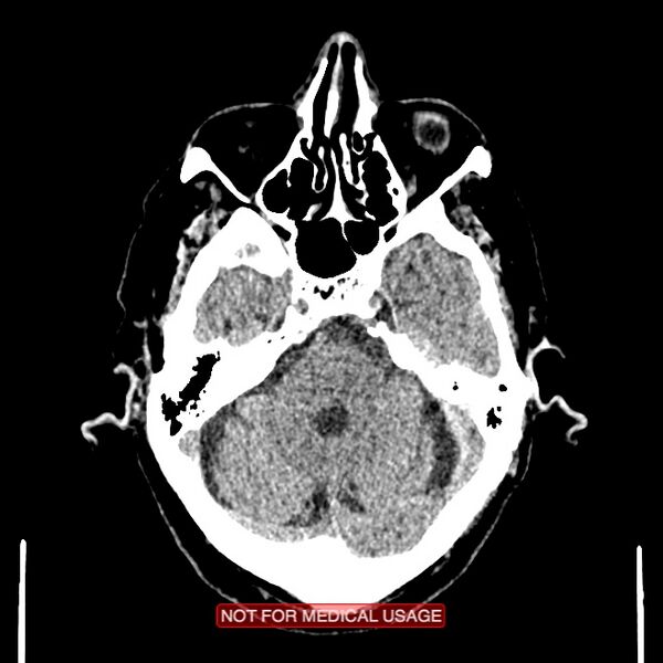File:Artery of Percheron infarction (Radiopaedia 28679-28967 Axial non-contrast 32).jpg
