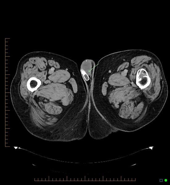 File:Artificial urethral sphincter (Radiopaedia 46937-51464 A 22).jpg