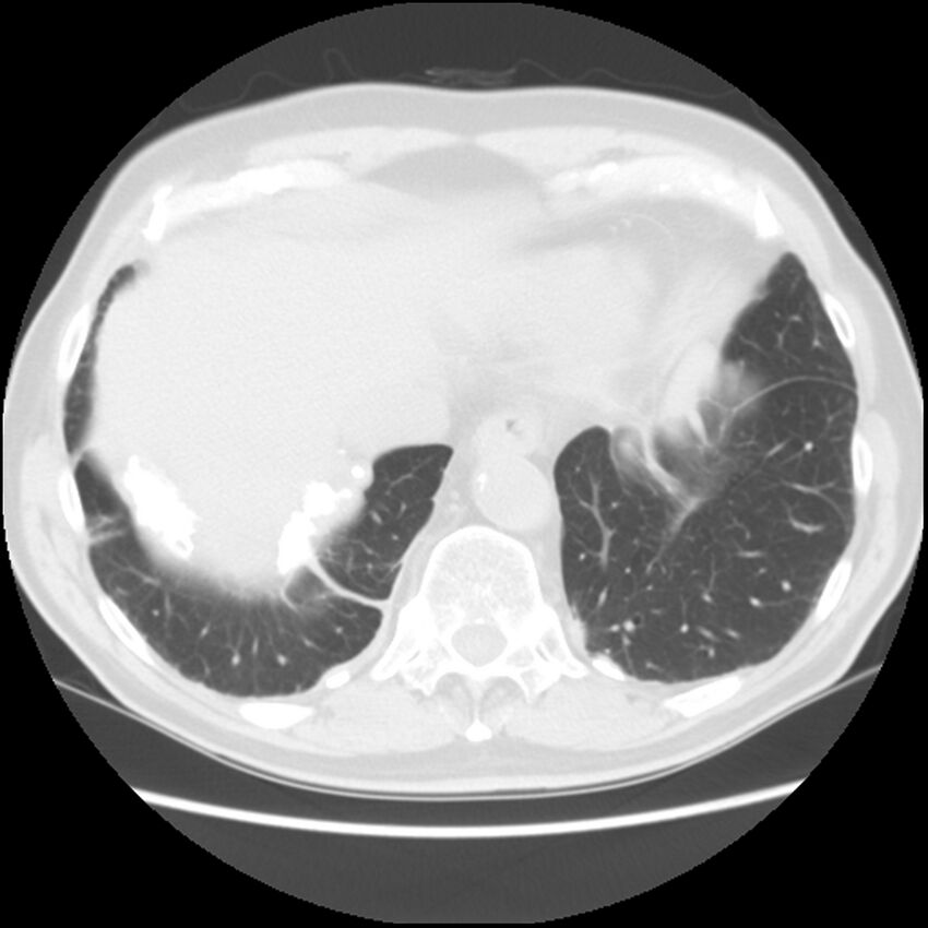 Asbestos-related pleural plaques (Radiopaedia 39069-41255 Axial lung window 59).jpg