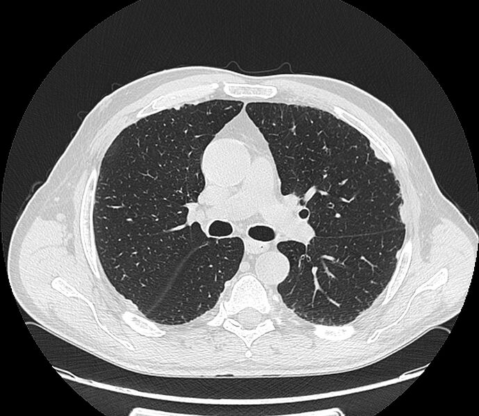 File:Asbestos pleural placques (Radiopaedia 57905-64872 Axial lung window 108).jpg