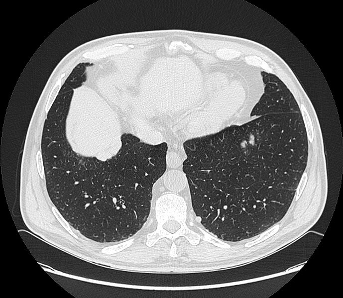 File:Asbestos pleural placques (Radiopaedia 57905-64872 Axial lung window 187).jpg