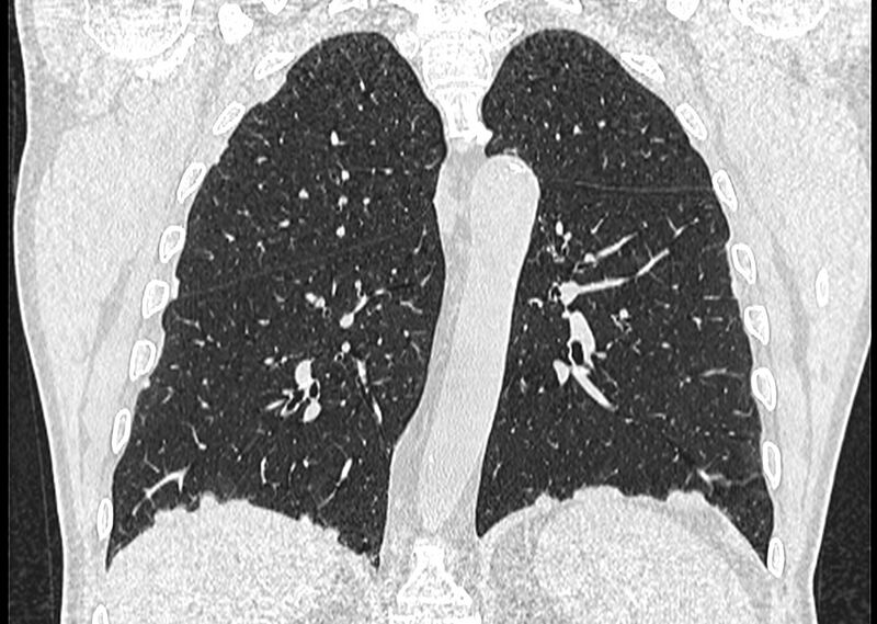 File:Asbestos pleural placques (Radiopaedia 57905-64872 Coronal lung window 192).jpg