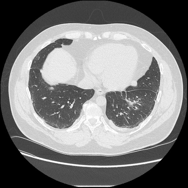 File:Asbestosis (Radiopaedia 45002-48961 Axial lung window 36).jpg