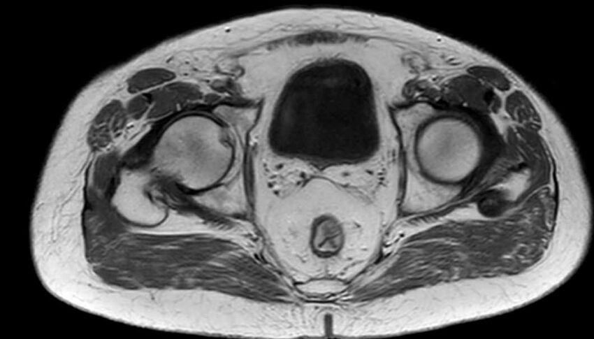 Atypical lipomatous tumor - thigh (Radiopaedia 68975-78734 Axial T1 94).jpg