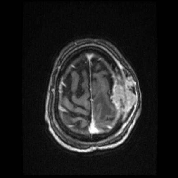 File:Atypical meningioma (Radiopaedia 45535-49629 Axial T1 C+ 58).jpg