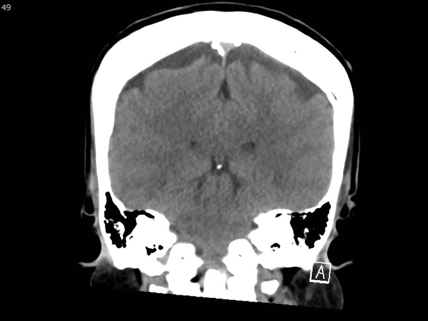 Atypical meningioma - intraosseous (Radiopaedia 64915-73867 B 48).jpg