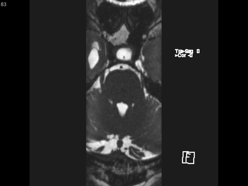 File:Atypical meningioma - intraosseous (Radiopaedia 64915-74572 Axial CISS 83).jpg
