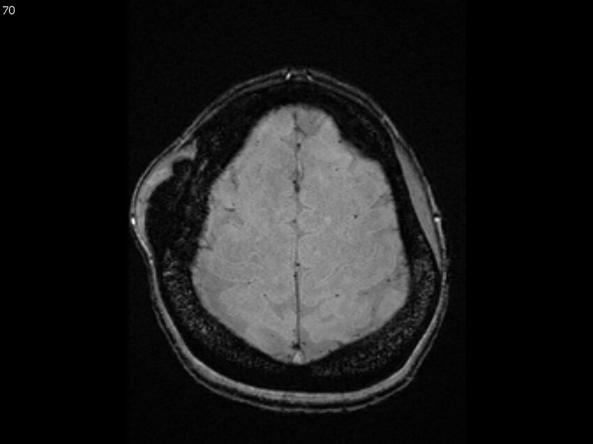Atypical meningioma - intraosseous (Radiopaedia 64915-74572 Axial SWI 70).jpg