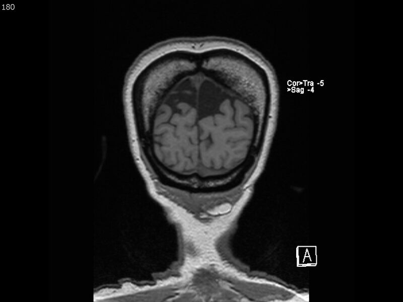 File:Atypical meningioma - intraosseous (Radiopaedia 64915-74572 Coronal T1 180).jpg