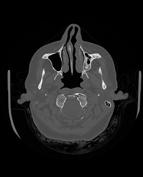 File:Automastoidectomy with labyrinthine fistula (Radiopaedia 84143-99411 Axial non-contrast 51).jpg