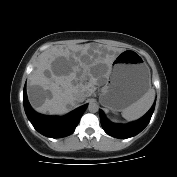 File:Autosomal dominant polycystic kidney disease (Radiopaedia 23061-23093 Axial non-contrast 13).jpg