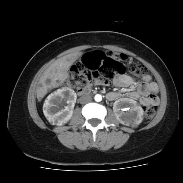 File:Autosomal dominant polycystic kidney disease (Radiopaedia 23061-23093 B 35).jpg