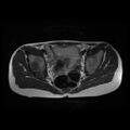 Avascular necrosis of the hip (Radiopaedia 29563-30067 Axial T2 2).jpg