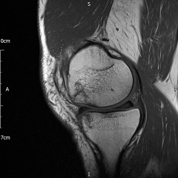 File:Avulsion fracture of the fibular head (Radiopaedia 74804-85808 D 11).jpg