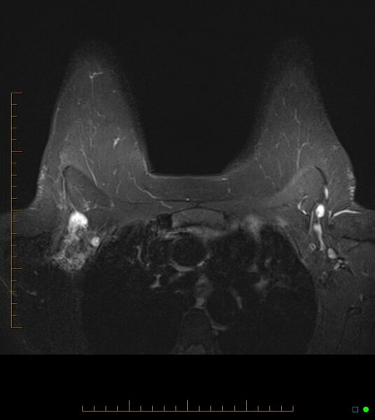 File:Axillary lymphadenopathy on breast MRI- yellow fever vaccination induced (Radiopaedia 19454-19483 Axial T2 fat sat 6).jpg