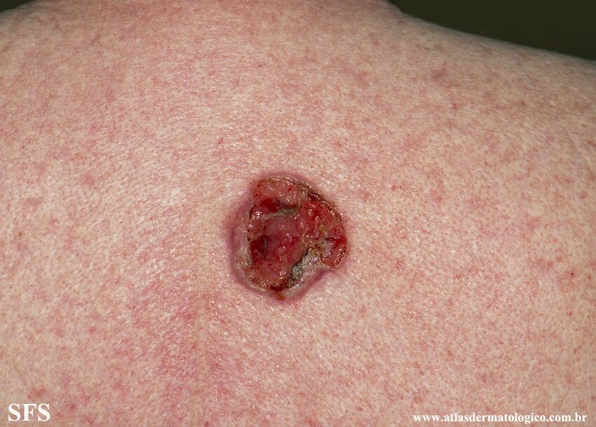 Basal Cell Carcinoma (Dermatology Atlas 276).jpg