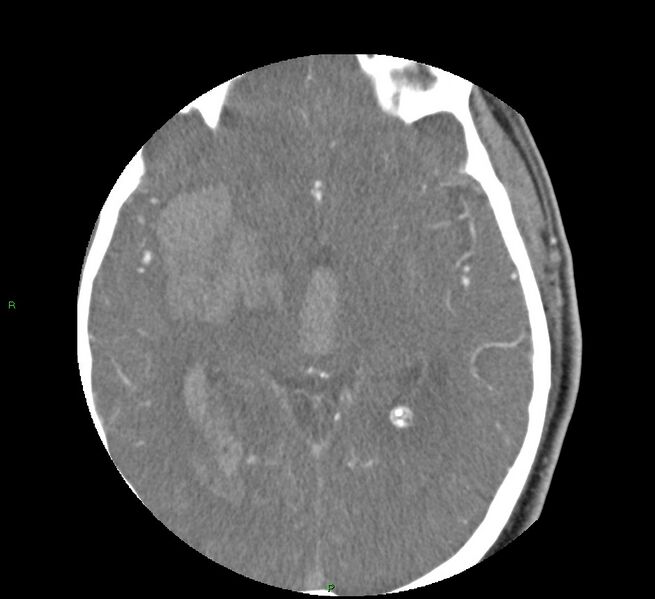 File:Basal ganglia hemorrhage (Radiopaedia 58763-65985 D 90).jpg