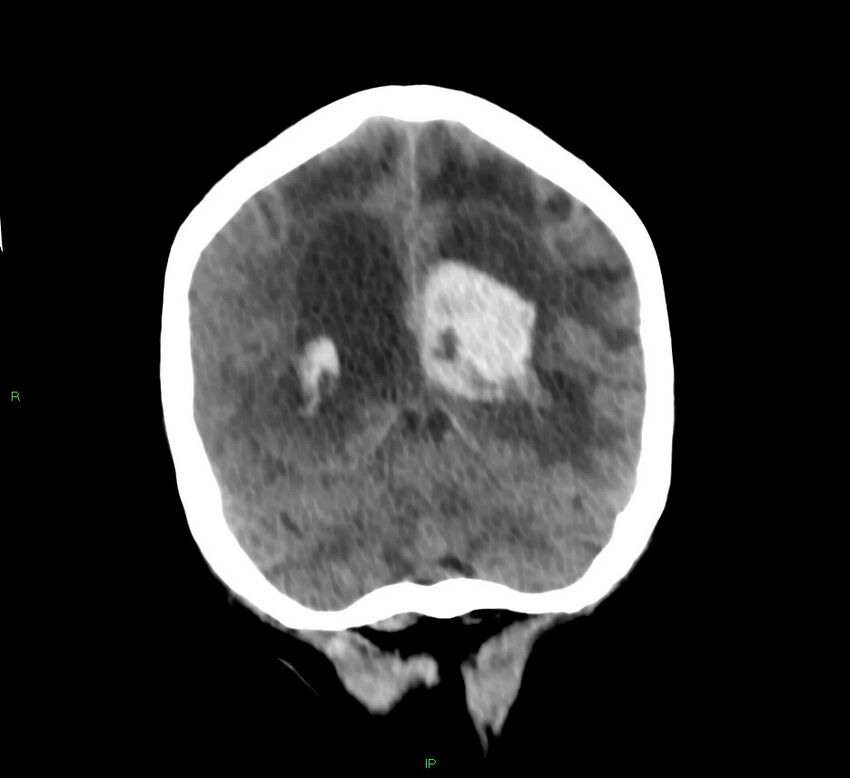 Basal ganglia hemorrhage (Radiopaedia 58766-65988 Coronal non-contrast 24).jpg