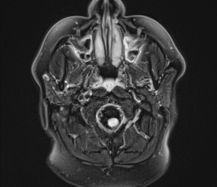 File:Basilar artery dissection (Radiopaedia 77032-88976 Axial FLAIR 2).jpg