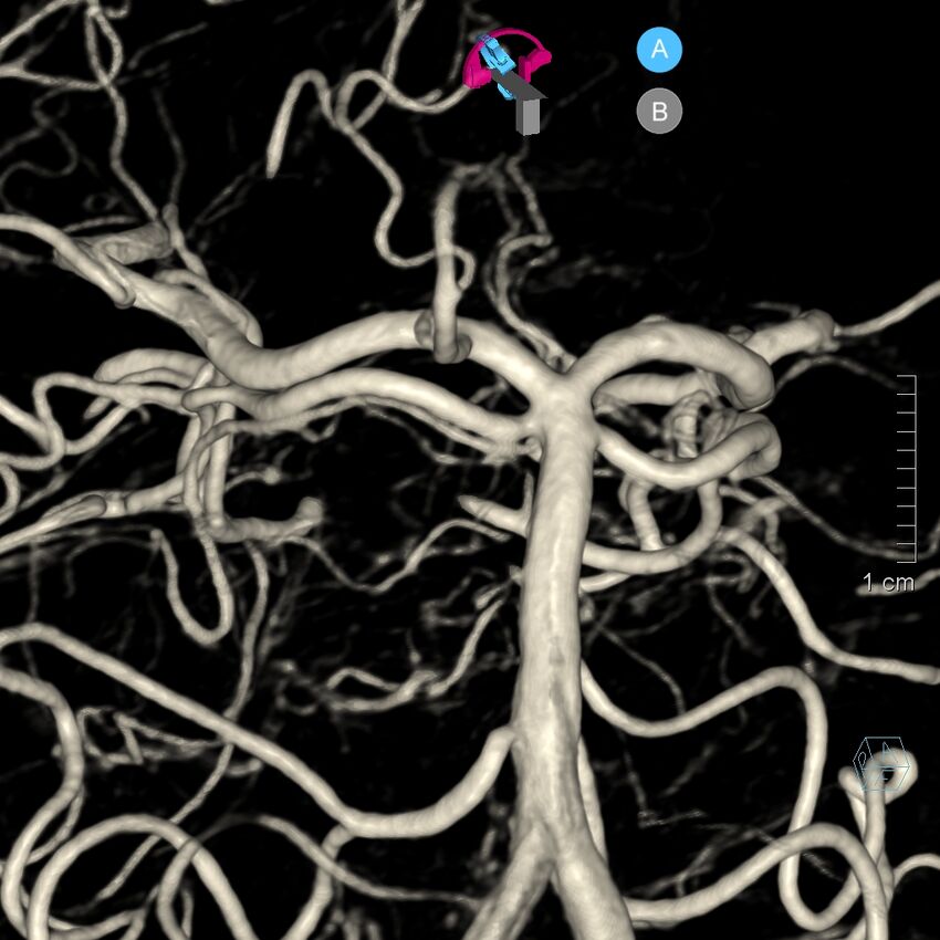 Basilar artery perforator aneurysm (Radiopaedia 82455-97734 3D view left VA 120).jpg
