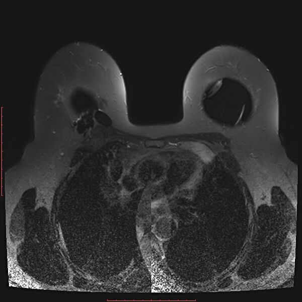 File:Bilateral breast implant rupture (Radiopaedia 24761-25027 T2 fat sat 15).jpg