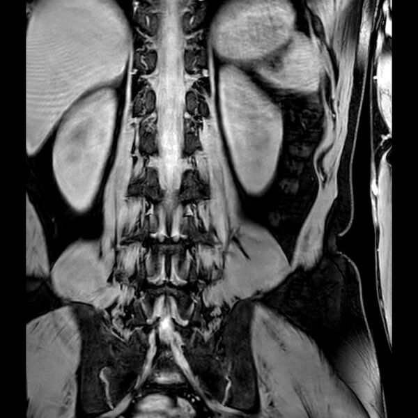 File:Bilateral conjoined nerve roots at different levels (Radiopaedia 73312-84063 B 34).jpg