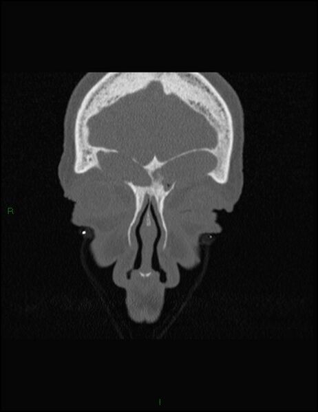 File:Bilateral frontal mucoceles (Radiopaedia 82352-96454 Coronal 67).jpg