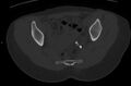 Bilateral mature cystic ovarian teratoma (Radiopaedia 88821-105592 Axial bone window 21).jpg