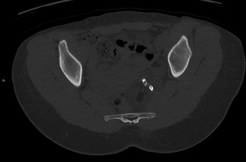 File:Bilateral mature cystic ovarian teratoma (Radiopaedia 88821-105592 Axial bone window 21).jpg