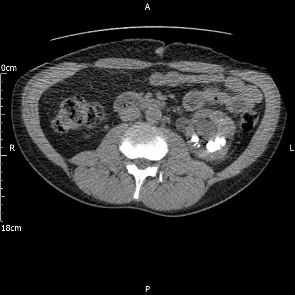 File:Bilateral medullary nephrocalcinosis with ureteric calculi (Radiopaedia 71269-81569 Axial non-contrast 56).jpg