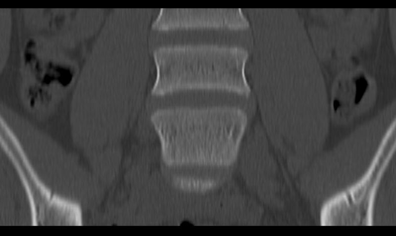 File:Bilateral pars defect (Radiopaedia 26691-26846 Coronal bone window 15).jpg