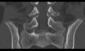 Bilateral pars defect (Radiopaedia 26691-26846 Coronal bone window 27).jpg