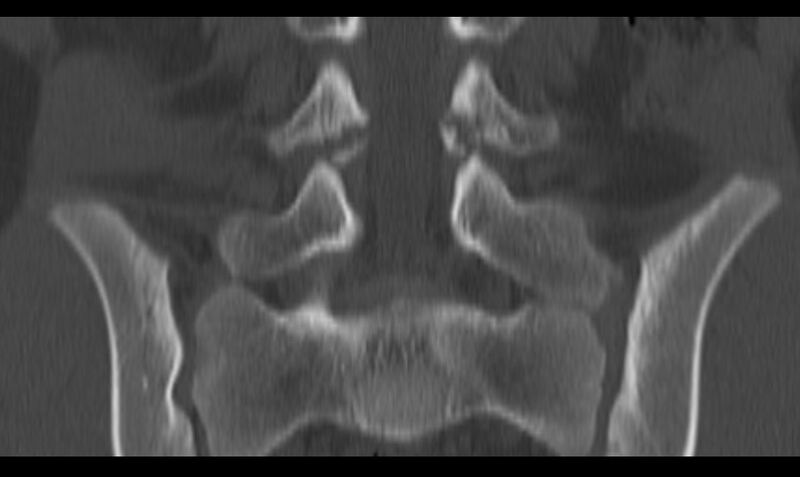 File:Bilateral pars defect (Radiopaedia 26691-26846 Coronal bone window 27).jpg