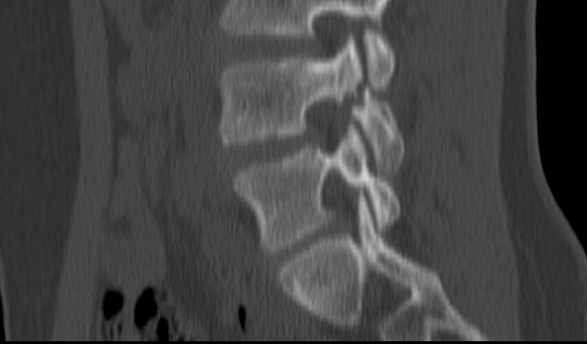 Bilateral pars defect (Radiopaedia 26691-26846 Sagittal bone window 24).jpg