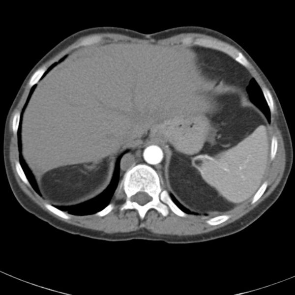 File:Biliary necrosis - liver transplant (Radiopaedia 21876-21845 A 10).jpg