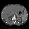 Biliary necrosis - liver transplant (Radiopaedia 21876-21846 A 24).jpg