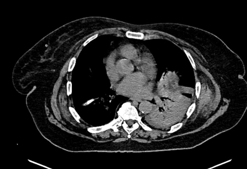 File:Biliary pancreatitis (Radiopaedia 72289-82823 Axial non-contrast 7).jpg