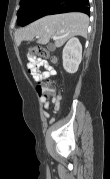 File:Bleeding duodenal ulcer and adenomyomatosis of gallbladder (Radiopaedia 61834-69861 C 25).jpg